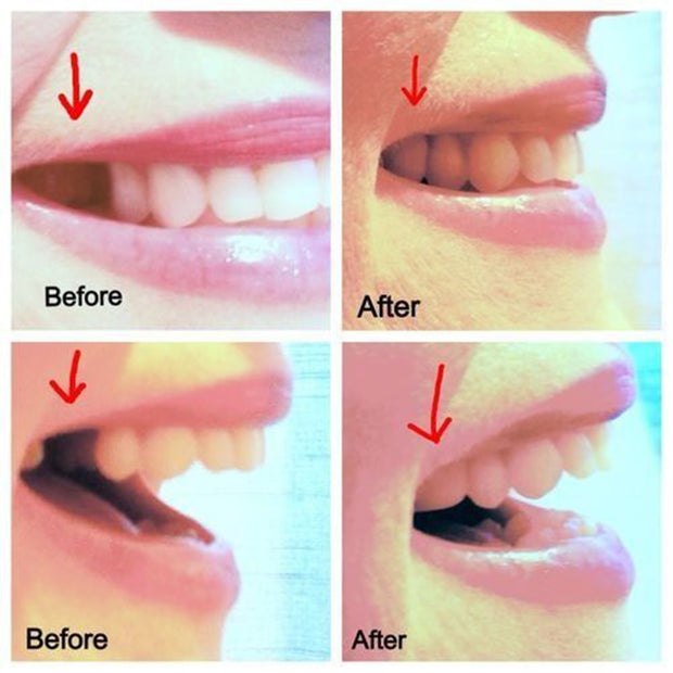 False Tooth Dentures Temporary Filling Material