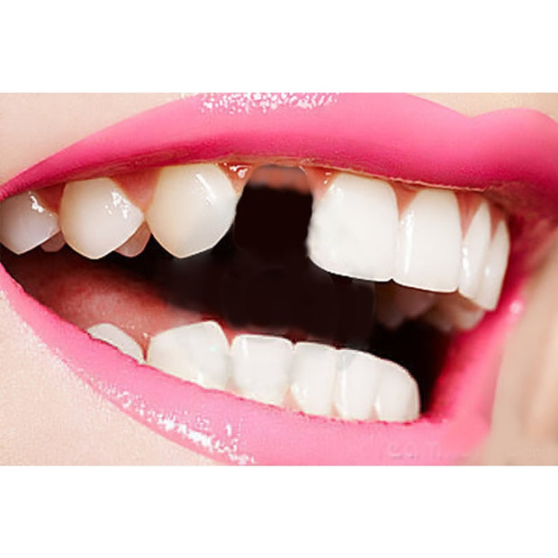 False Tooth Dentures Temporary Filling Material